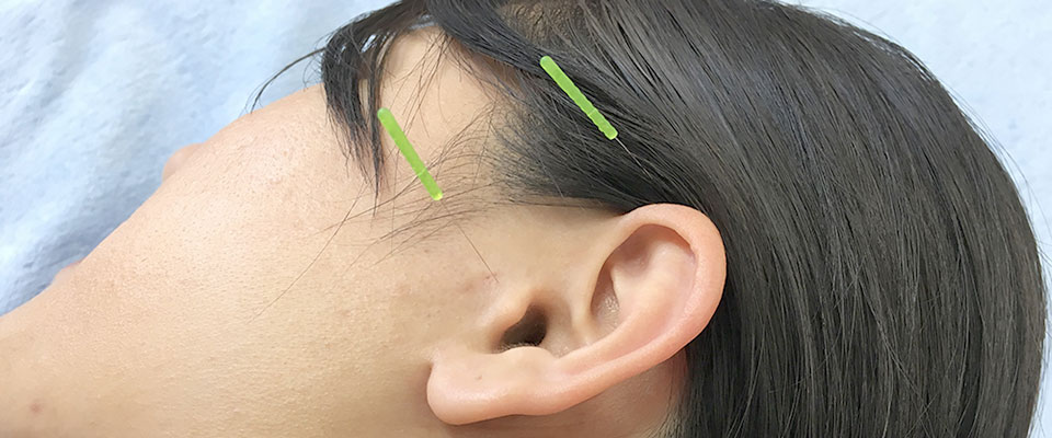 突発性難聴の治療