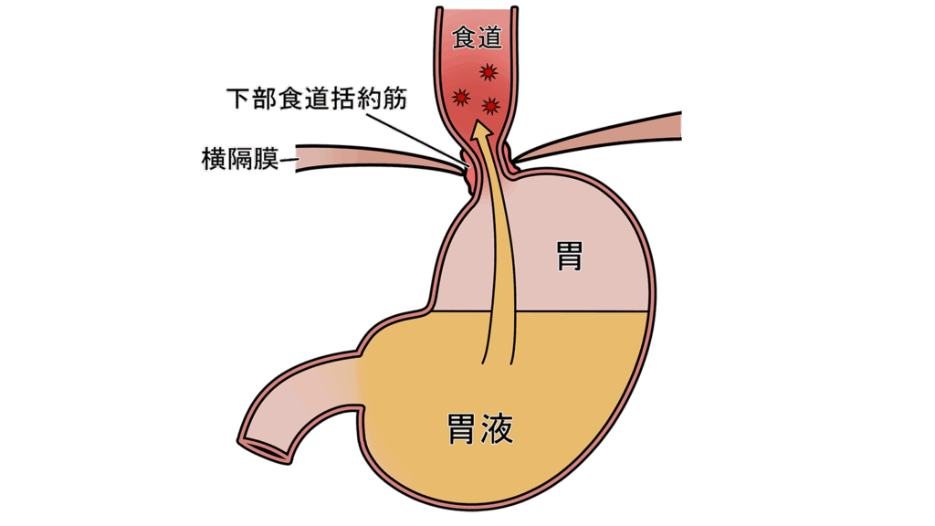 豊橋逆流性食道炎治療