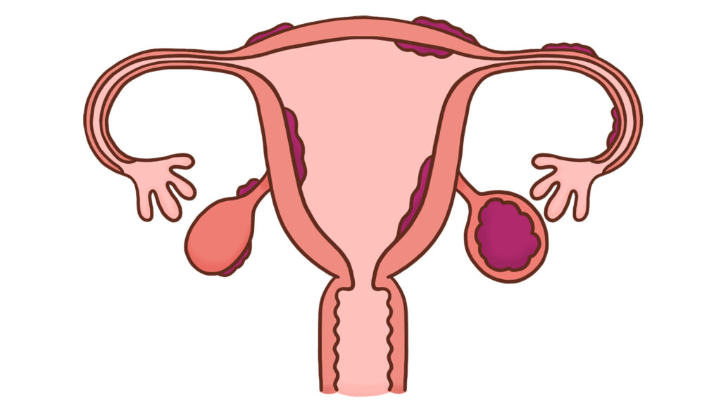 豊橋子宮内膜症治療