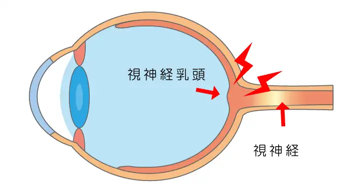 視神経炎